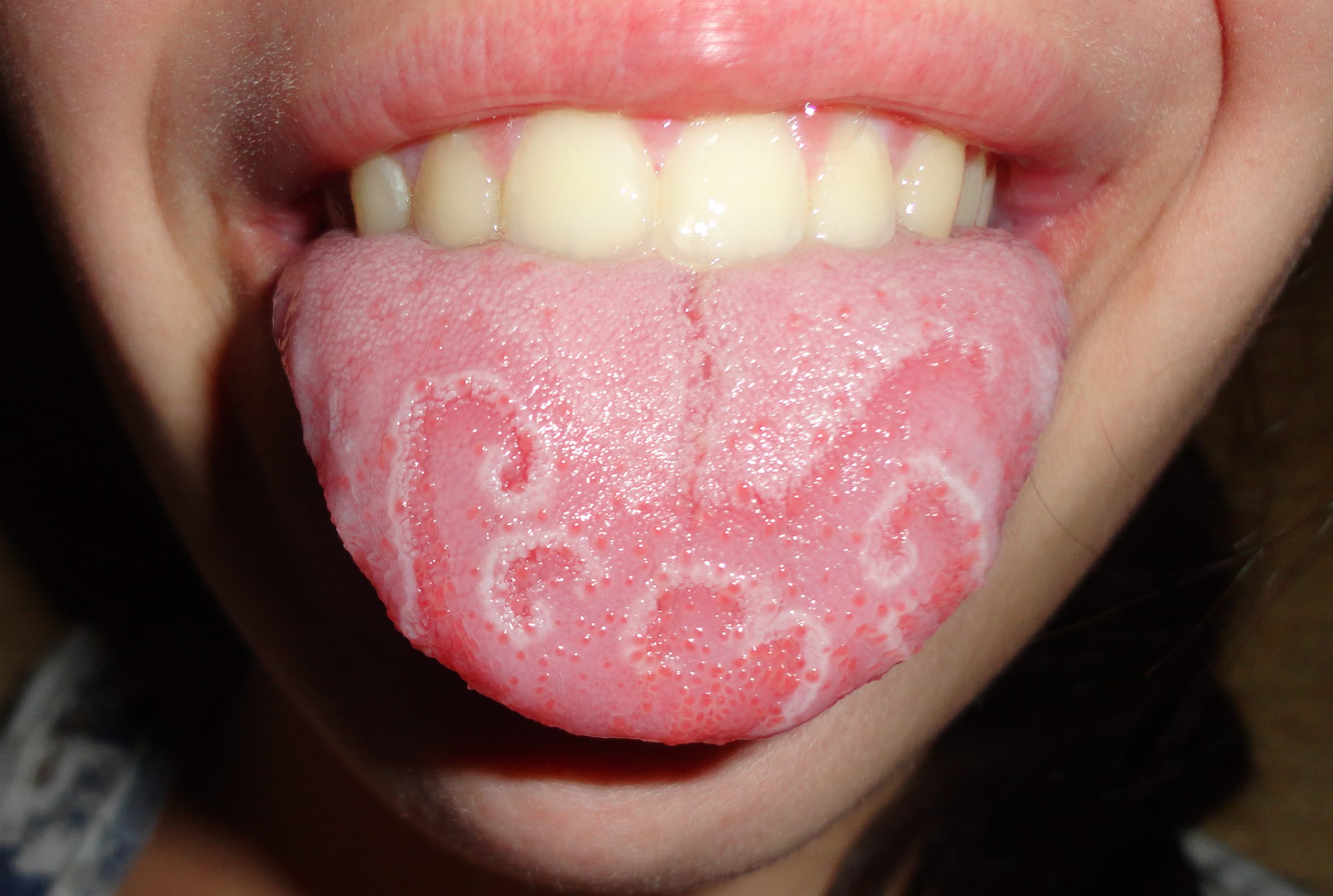 Dehydrated Tongue